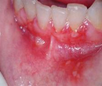 candidiasis infection