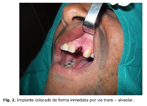 Tratamiento de fractura radicular mediante implante post ...